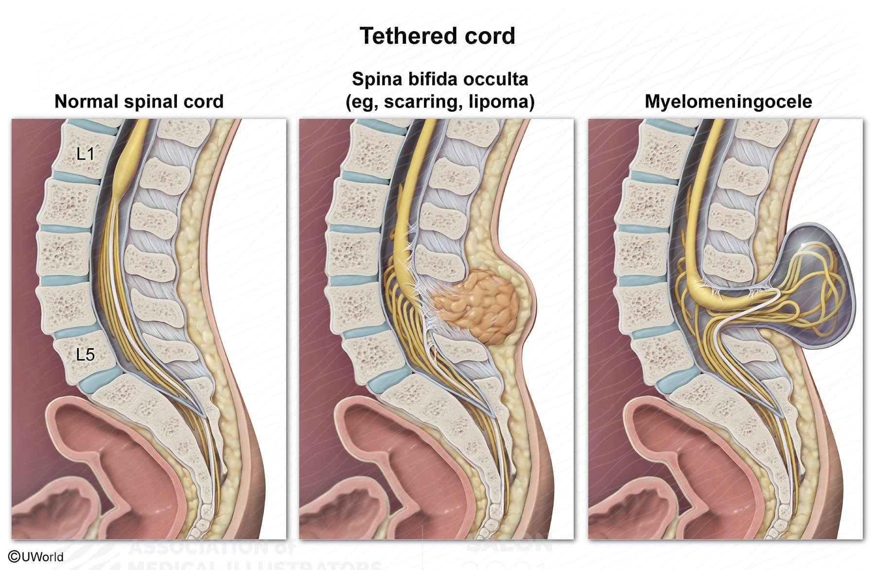 Spine Detethering Surgery